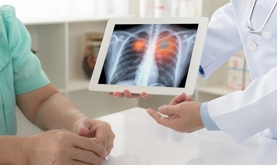 University Hospitals of Leicester goes live with AI-reviewed chest x-rays