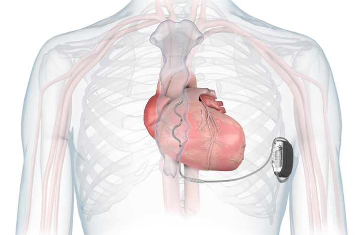 NICE approves remote monitoring tools for heart failure patients